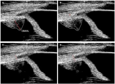 Ultrasound biomicroscopy analysis of ciliary muscle dynamics and its relation to intra-ocular pressure after phacoemulsification in dogs